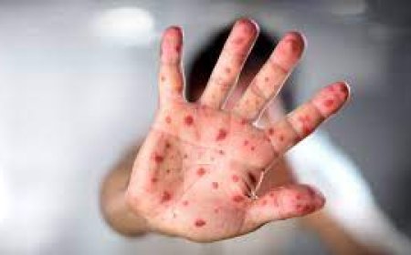 «80 пайызы балалар»: Елімізде қызылша жұқтырғандардың саны 30 мыңнан асты