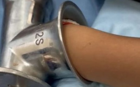 Алматы облысында 12 жастағы қыздың саусақтарын еттартқыш жұлып кетті