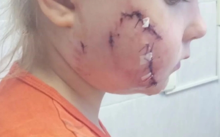 Қарағандыда кішкентай қыздың бетін жұлып алған иттің иесі 40 мың теңге айыппұлмен құтылатын болды