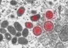 Маймыл шешегі Еуропаға жетті - Швецияда бір науқас аурханаға түсті
