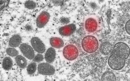 Маймыл шешегі Еуропаға жетті - Швецияда бір науқас аурханаға түсті