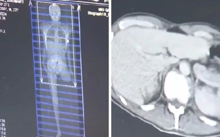 Коронавирустан кейін балалардың миы қартайып кеткен