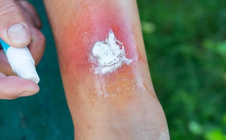 «Кішкентай жарадан басталып, іріңдейді»: Түркістан облысында инфекциялық ауру таралып жатыр