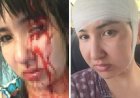 «120 келі салмағымен үстіме отырып алды». Атырау тұрғыны депутат күйеуінің қорлығынан кейін жүре алмай қалғанын айтты