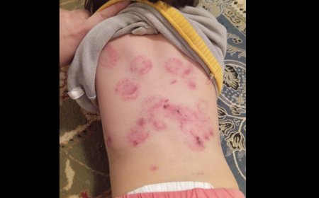 «Ит талағандай»: Қызылордадағы балабақшада бір жарым жастағы қызды әлдекім тістелеп тастаған