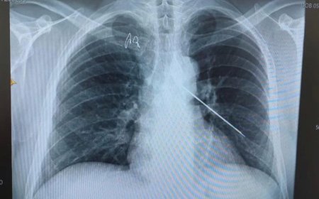 Қызылордада дәрігерлер науқастың кеудесінен 10 сантиметр сым алды