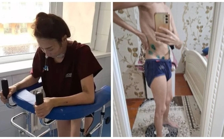 «Өлім аузынан қалдым»: Талдықорғанда дәрігерлер әйелдің жатырын рұқсатсыз алып тастаған