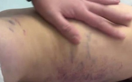 Әкесінен аяусыз соққы жеген үш жастағы қыздың жағдайы белгілі болды