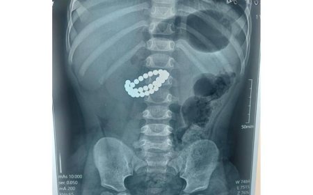 Алматыда екі жасар бала 31 магнит жұтып қойған