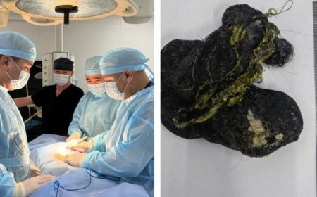 Шымкентте 8 жастағы баланың асқазанынан ірі көлемде шаш алынды