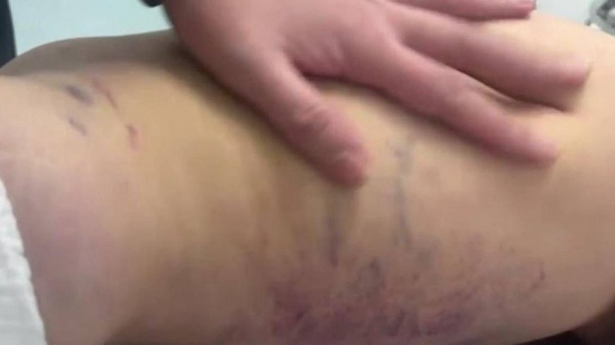 Әкесінен аяусыз соққы жеген үш жастағы қыздың жағдайы белгілі болды