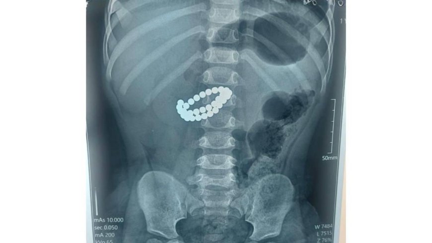 Алматыда екі жасар бала 31 магнит жұтып қойған