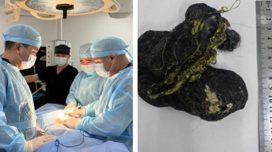 Шымкентте 8 жастағы баланың асқазанынан ірі көлемде шаш алынды