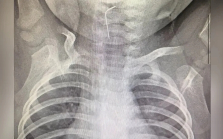 «Өңішке қадалған»: Түркістан облысында тоғыз айлық бала ине жұтып қойған