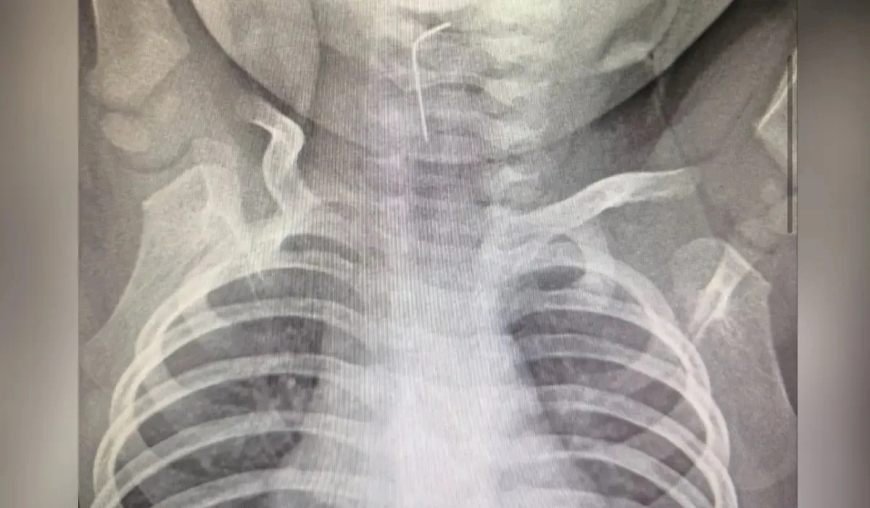 «Өңешке қадалған»: Түркістан облысында тоғыз айлық бала ине жұтып қойған